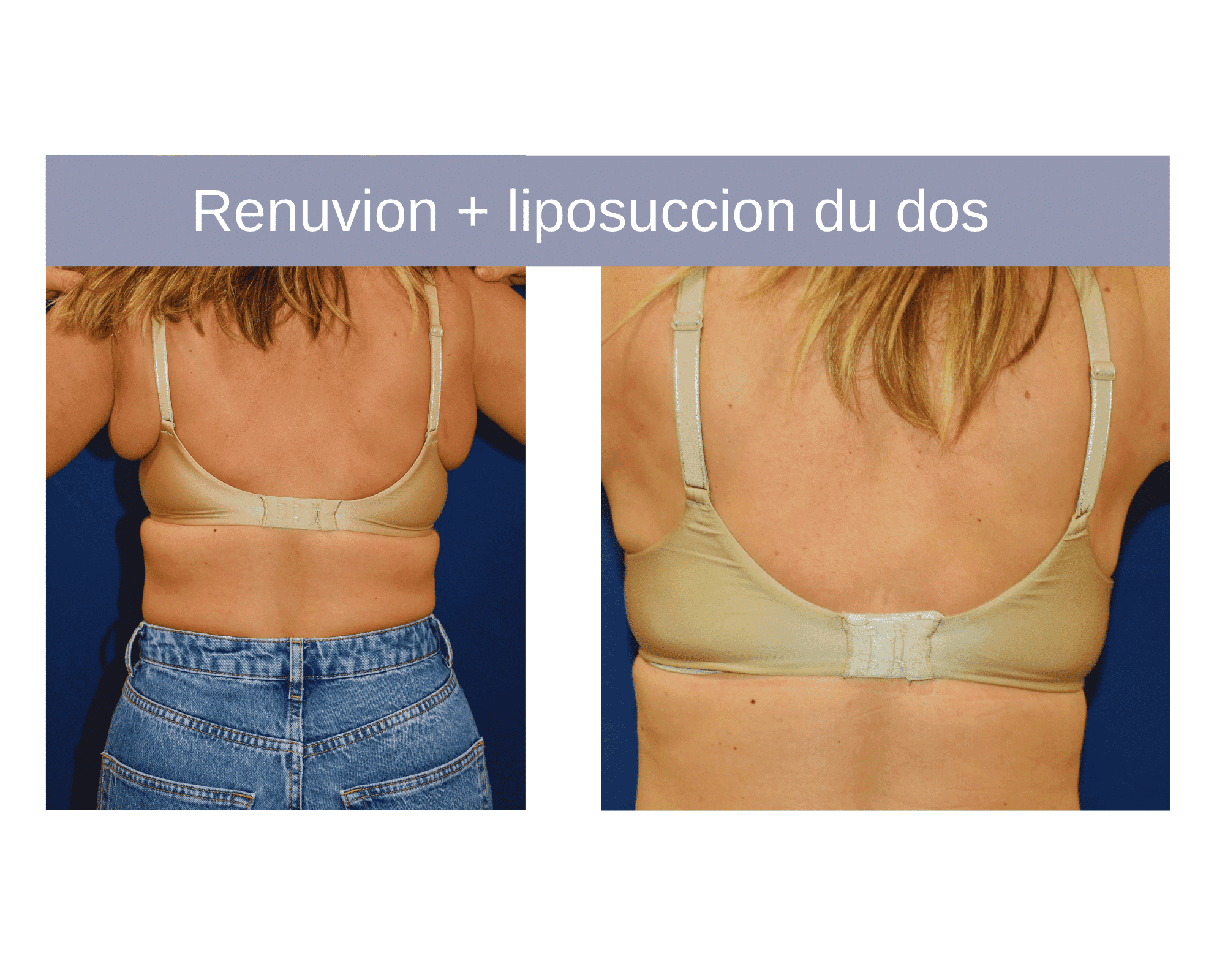 photo renuvion dos